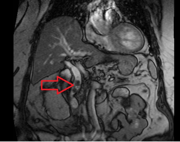 choledocholithiasis (gallstones in the common bile duct) t2 TRUFISP coronal image