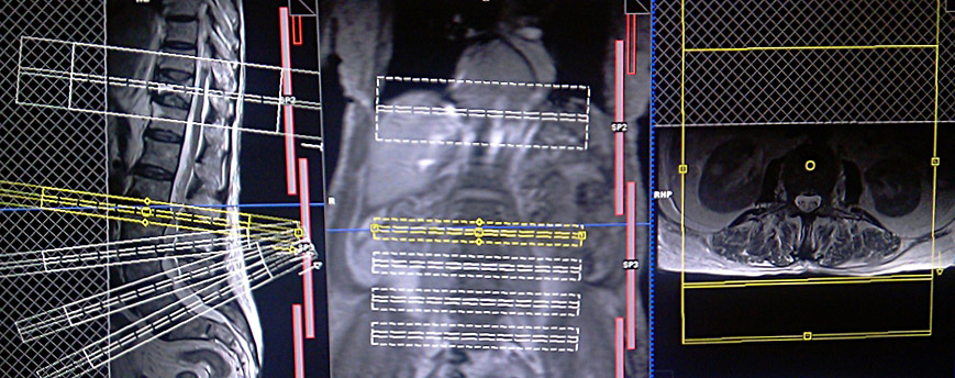 lumber spine MRI single block planning for a patient with multiple disc prolapse and fracture