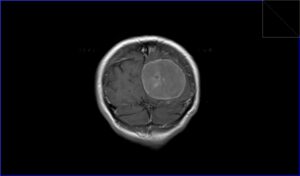 Meningioma MRI