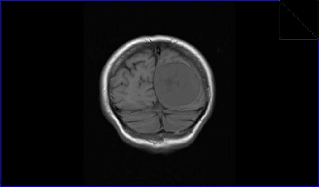 Meningioma Mri