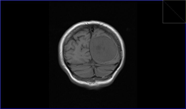 Meningioma MRI