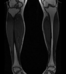 Mri Leg Performance PLAN%20MRA%20LEGS%20t1%20flash%20coronal%20lower%20leg%20pre - mrimaster