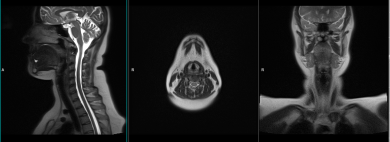 Larynx MRI Planning and Protocols | Indications for MRI Larynx