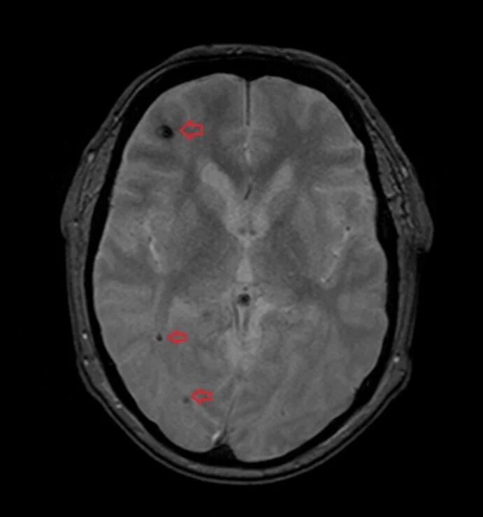 Blooming artifact T2 star (SWI) MRI Brain Hemorrhage