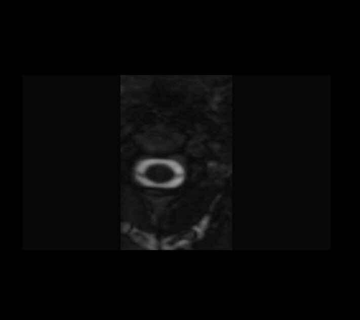 CISS 3D axial reconstruction of cervical spinal cord