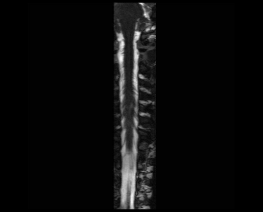 CISS 3D coronal reconstruction of cervical spinal cord