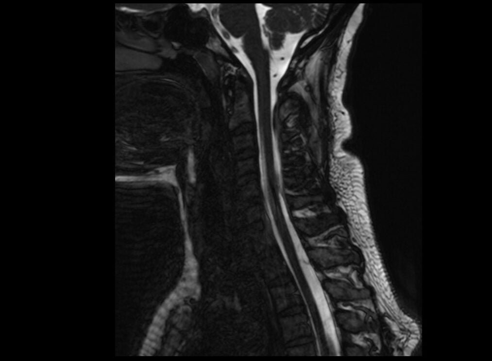 CISS 3D image of cervical spine