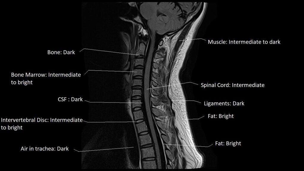 FLAIR Vs STIR MRI FLAIR Vs STIR MRI Image Comparison