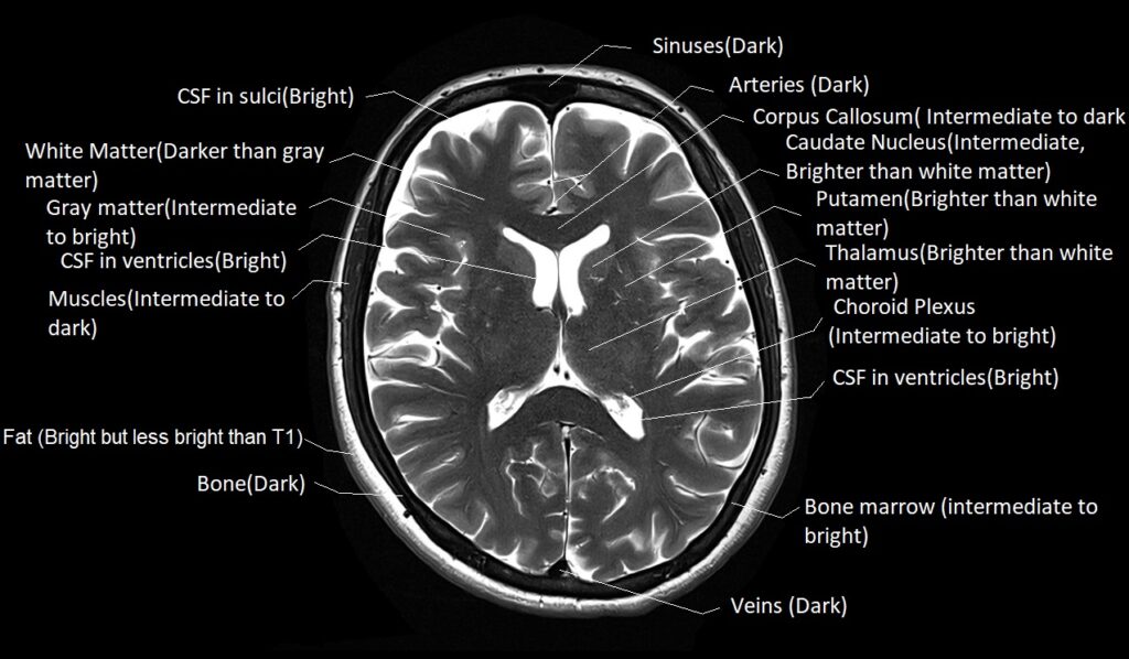 Labelled T2 MRI image showing the T2 appearance of various tissues in the brain