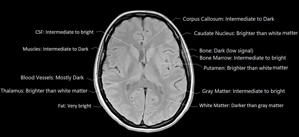 Labelled proton density image showing the PD appearance of various tissues in the brain