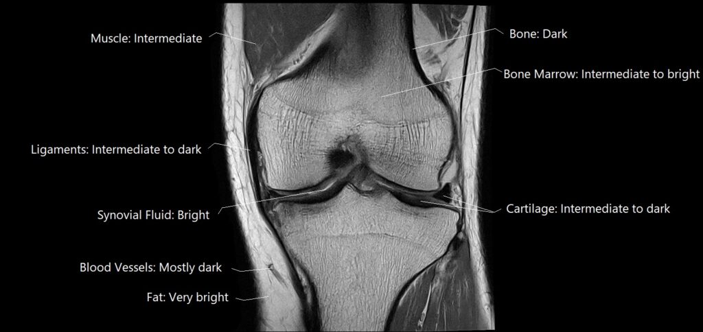 Labelled proton density knee image showing the PD appearance of various tissues in the joints