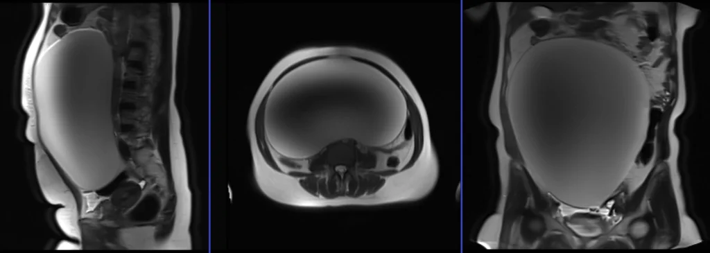 MRI LARGE ABDOMEN AND PELVIC MASSES localiser image