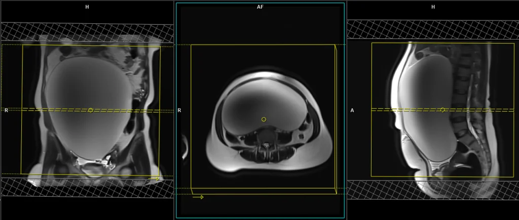 MRI Large abdomen and Pelvic Masses and protocol and planing of axial scans