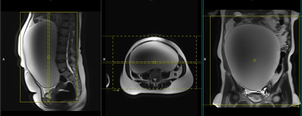 MRI Large abdomen and Pelvic Masses and protocol and planing of coronal scans