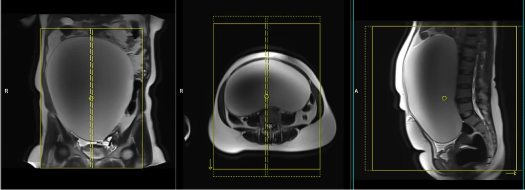 MRI Large abdomen and Pelvic Masses and protocol and planing of sagittal scans