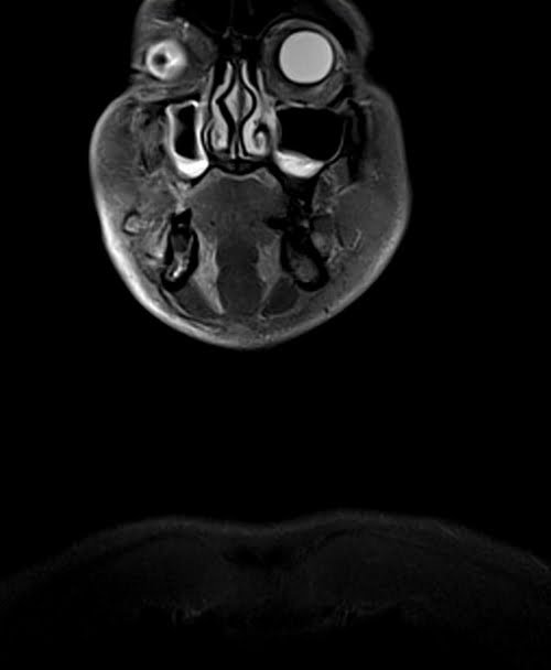 MRI NECK CORONAL STIR IMAGE 1