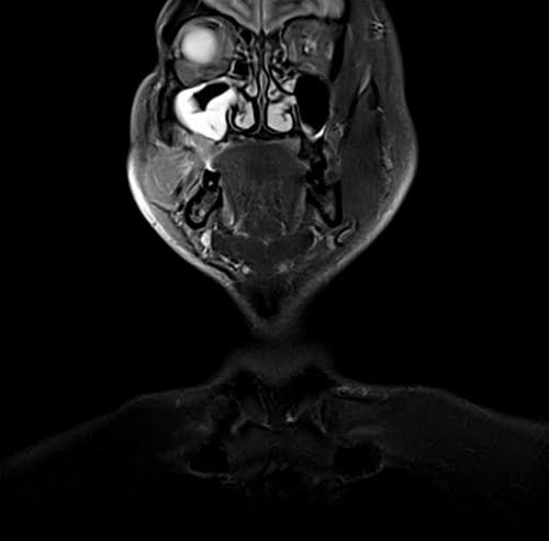 MRI NECK CORONAL STIR IMAGE 2