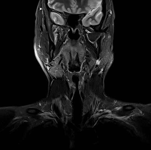 MRI NECK CORONAL STIR IMAGE 4