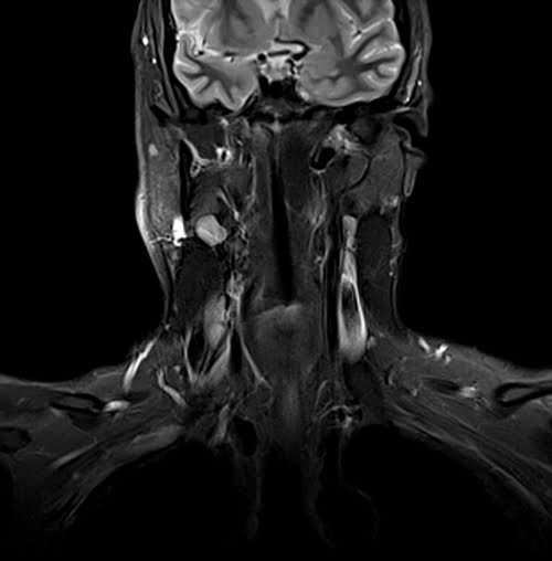 MRI NECK CORONAL STIR IMAGE 5