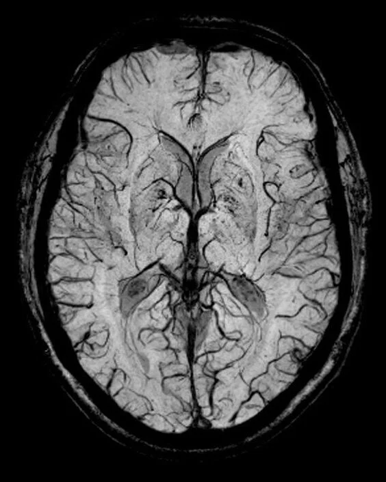 MRI Susceptibility weighted image (SWI image) MRI
