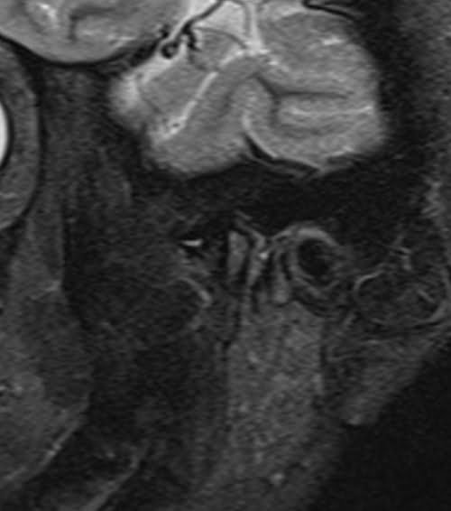 MRI tmj sag STIR image 1