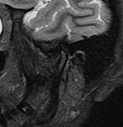 MRI tmj sag STIR image 2
