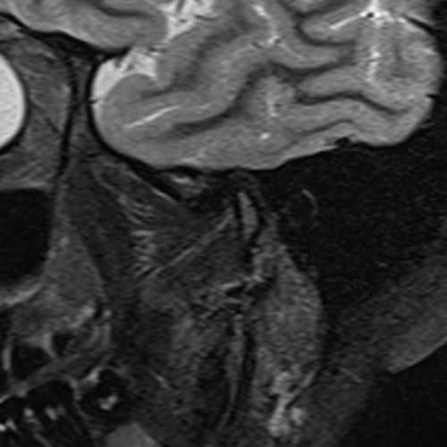 MRI tmj sag STIR image 3