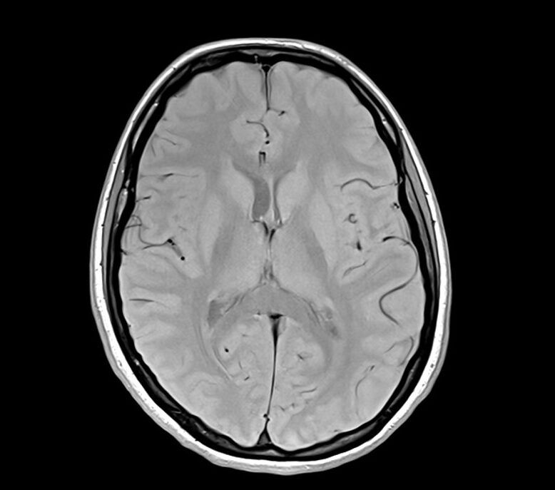 PD Axial sequence used in brain imaging