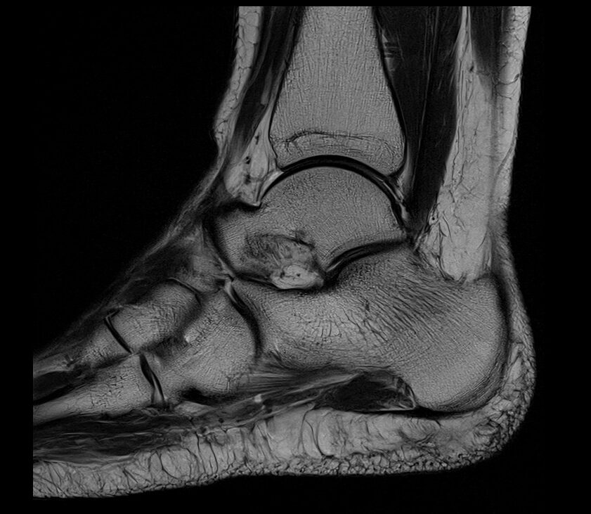 PD sagittal image usd in ankle imaging