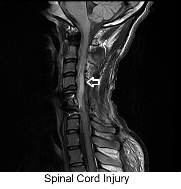 FLAIR MRI FLAIR MRI Sequence Physics Image And Pathology Appearance