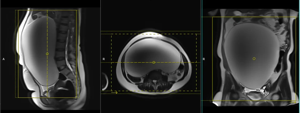 T1 VIBE DIXON 3D coronal dynamic abdomen and pelvis protocol and planning