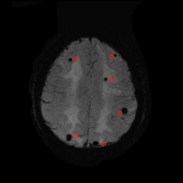 T2 star (SWI) image of Brain