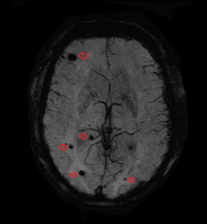 T2 star (SWI) image of Brain Hemorrhage