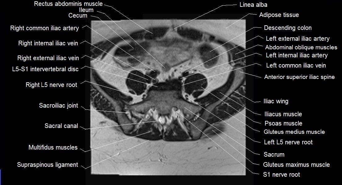 mri female pelvis anatomy axial image 1