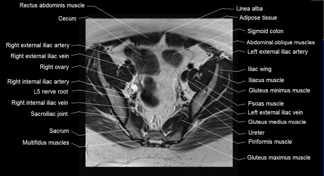 mri female pelvis anatomy axial image 10
