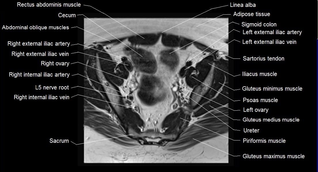 mri female pelvis anatomy axial image 11