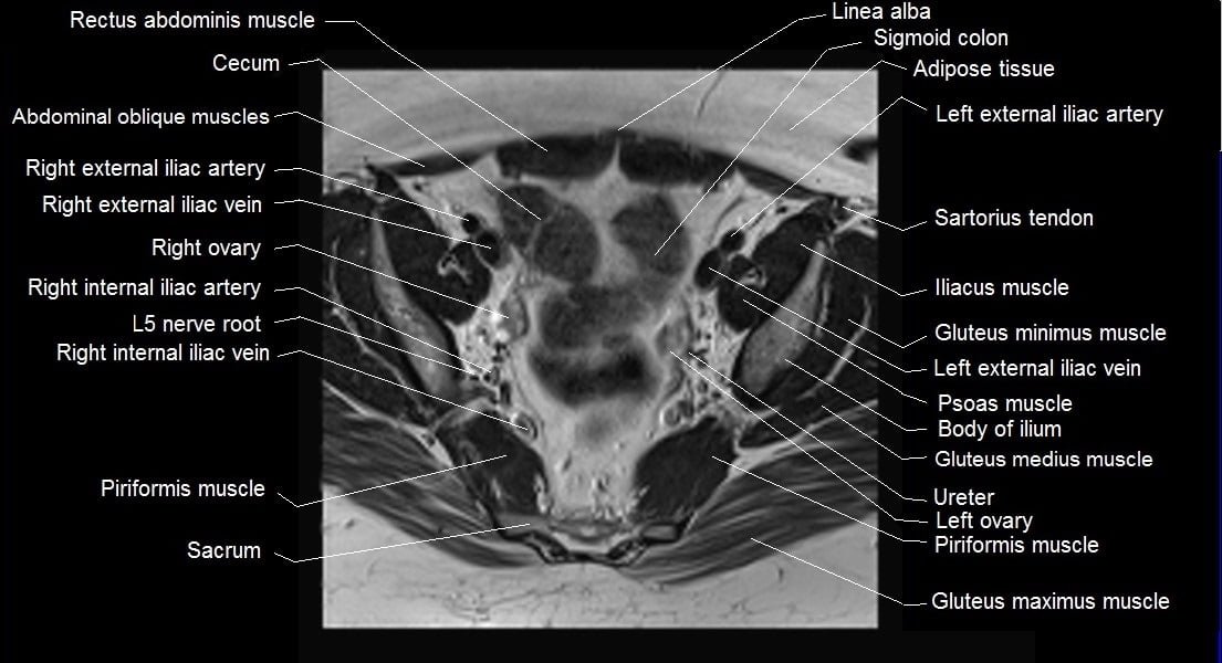 mri female pelvis anatomy axial image 12