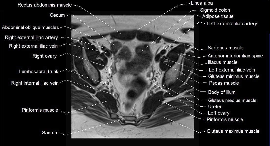 mri female pelvis anatomy axial image 13