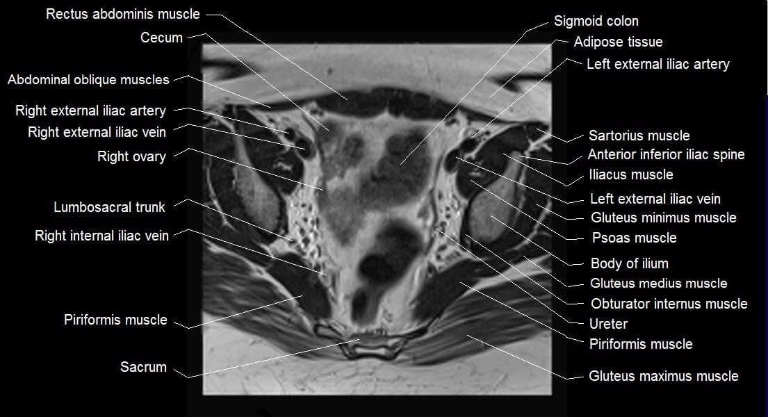 mri female pelvis anatomy axial image 14