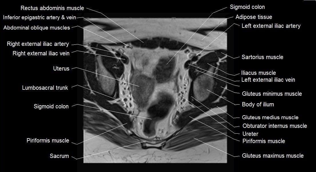 mri female pelvis anatomy axial image 15