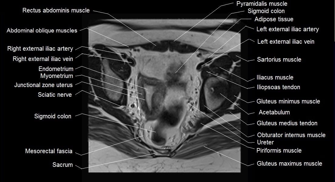 mri female pelvis anatomy axial image 16