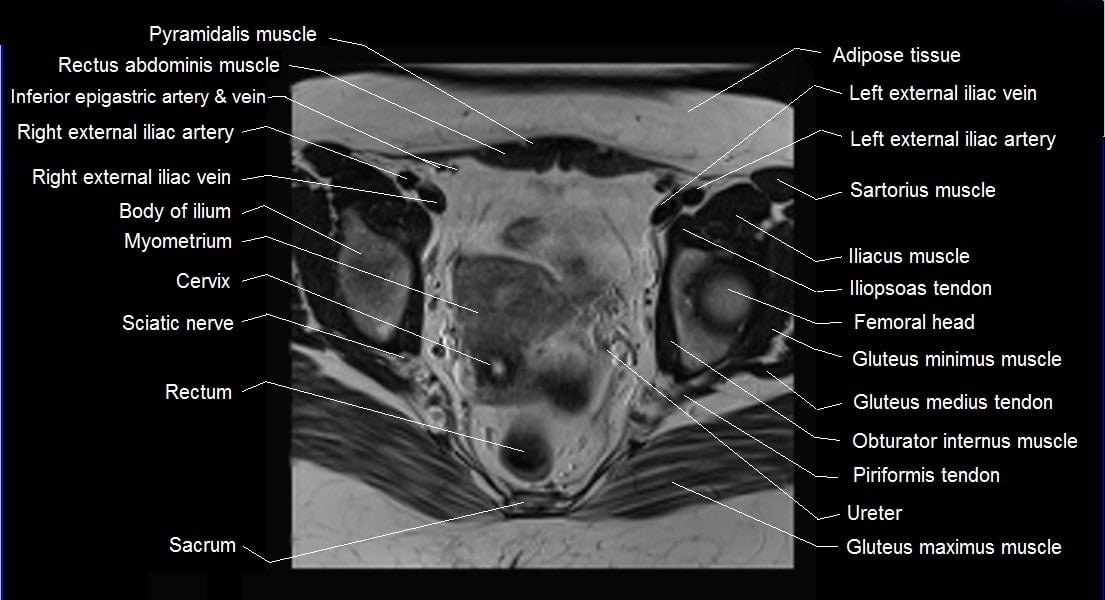 mri female pelvis anatomy axial image 17