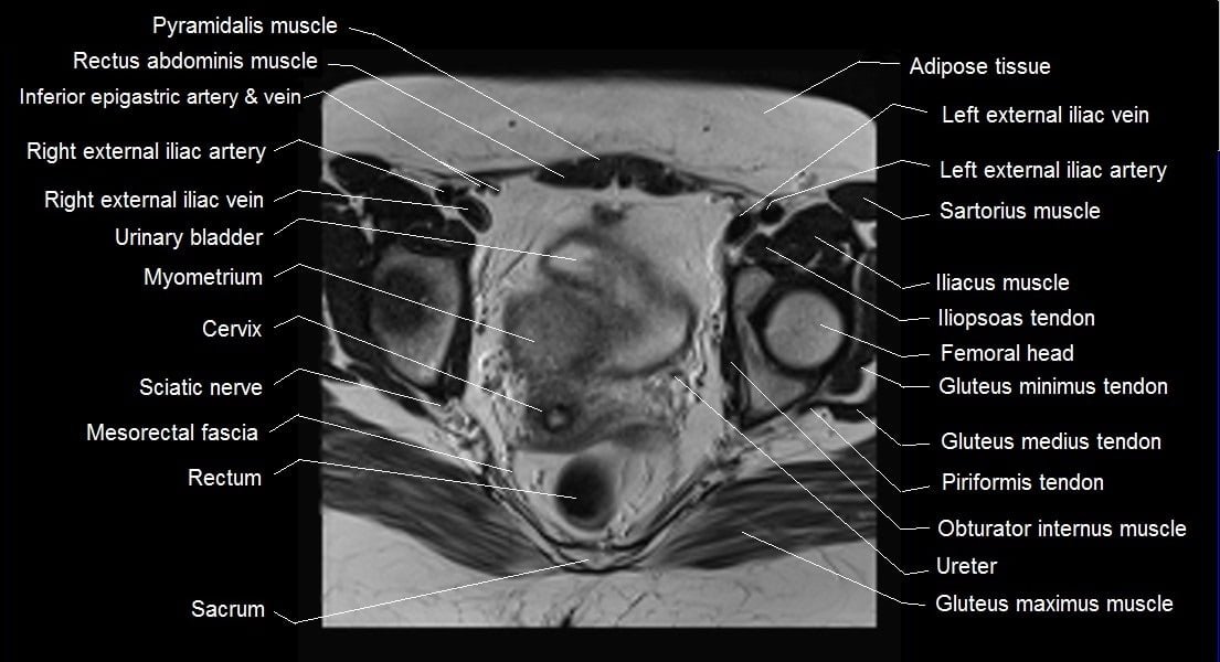 mri female pelvis anatomy axial image 18