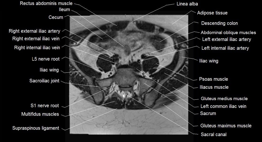 mri female pelvis anatomy axial image 2
