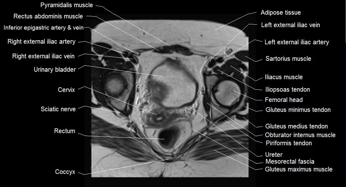 mri female pelvis anatomy axial image 19