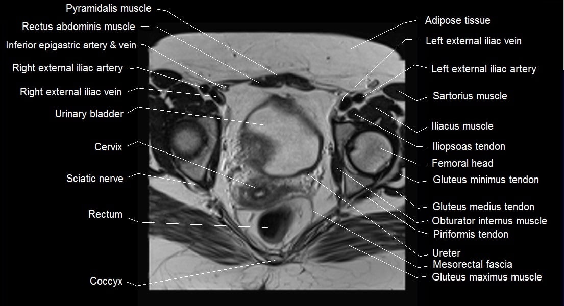 Female pelvis anatomy | Free axial cross sectional anatomy of female pelvis