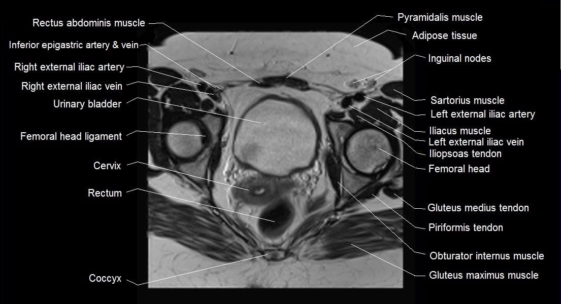 mri female pelvis anatomy axial image 20