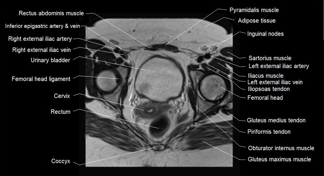 Female pelvis anatomy | Free axial cross sectional anatomy of female pelvis