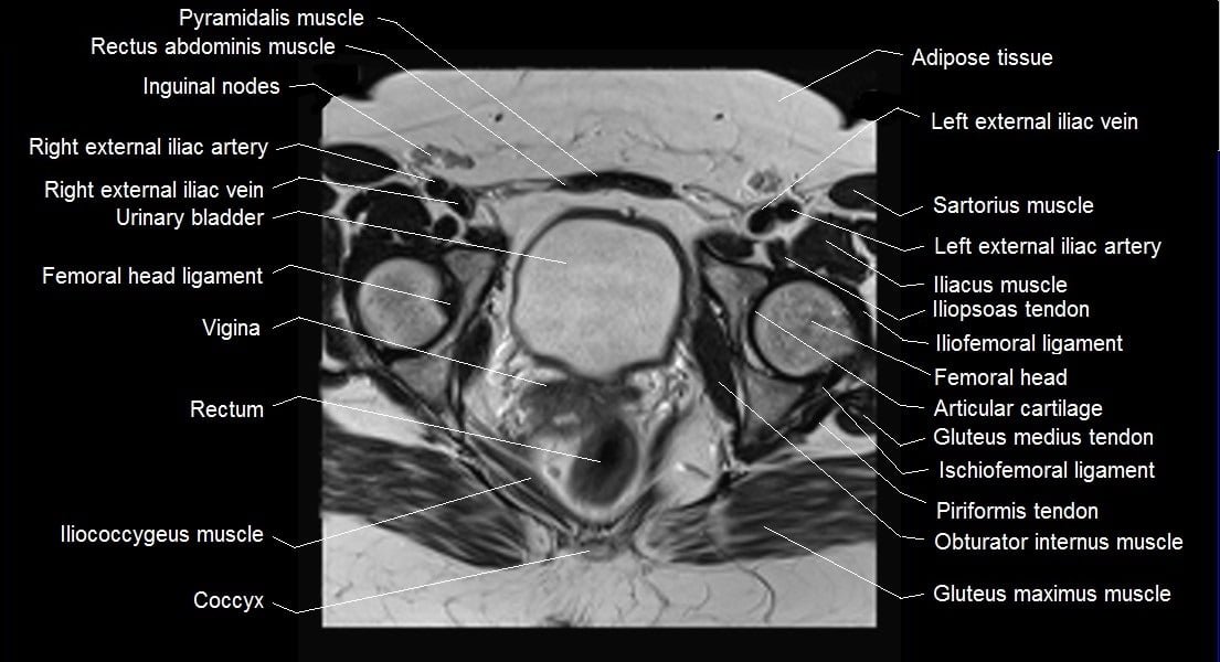 mri female pelvis anatomy axial image 21