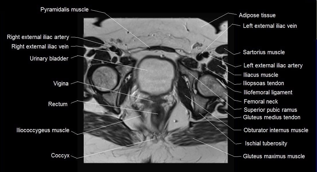 mri female pelvis anatomy axial image 22